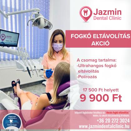 Fogkő Eltávolítás Akció Fogkő Eltávolítás Akció