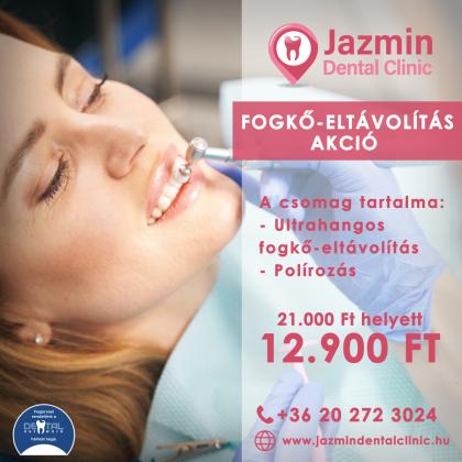 Fogkő eltávolítás AKCIÓ