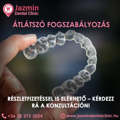 Átlátszó fogszabályozás részletfizetéssel Átlátszó fogszabályozás részletfizetéssel